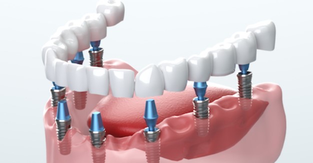 The Latest Advancements in Dental Implant Technology